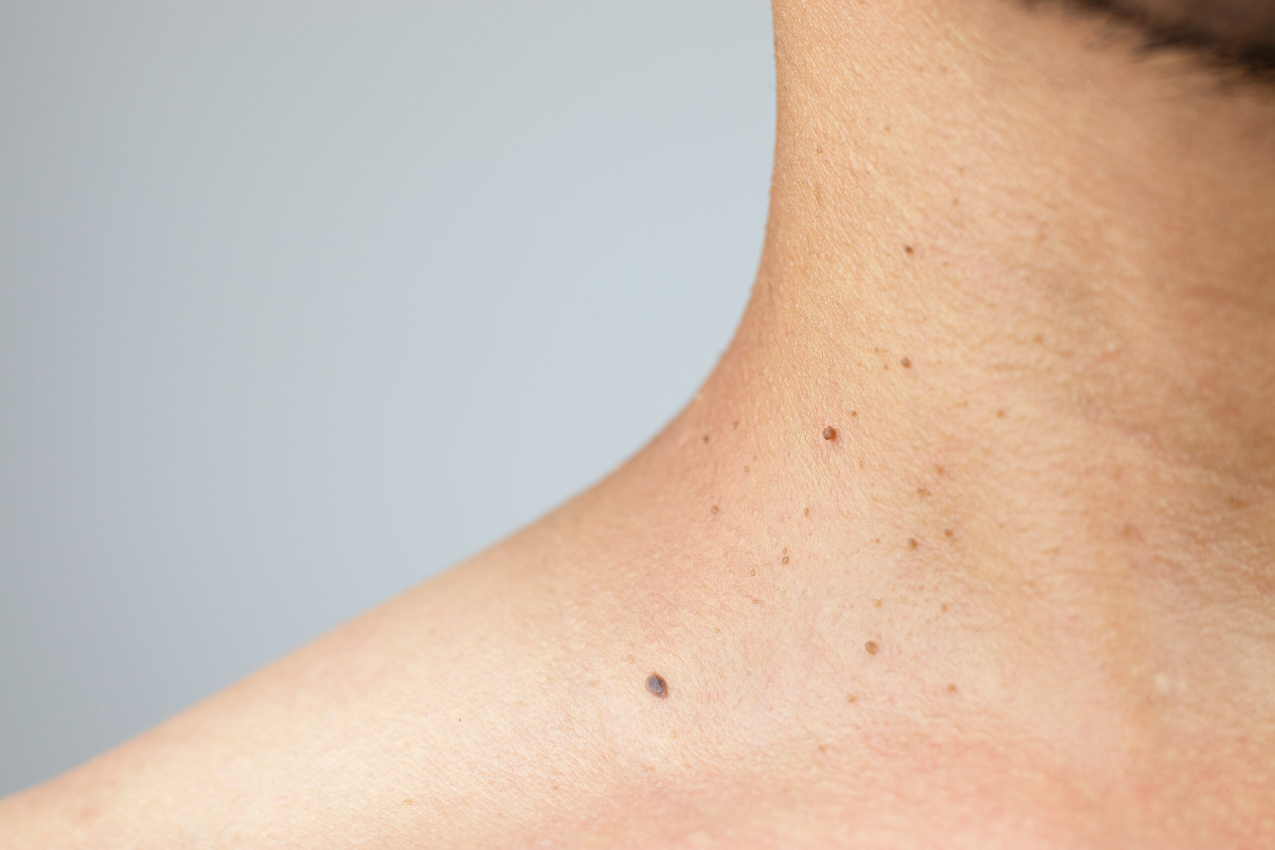 Skin Tags