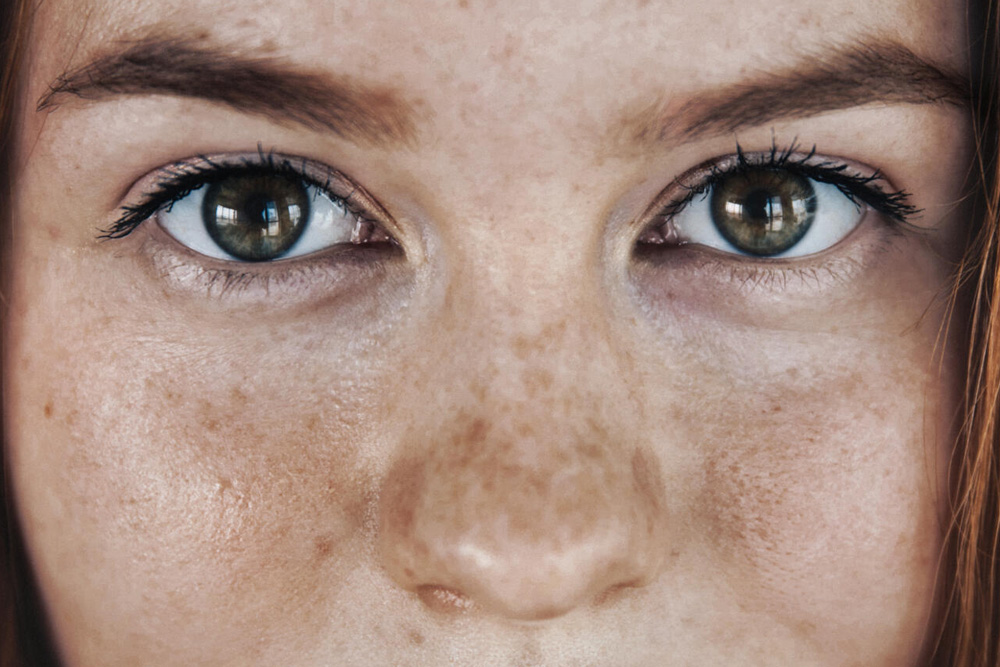 Levulan PhotoDynamic Therapy - Westside Dermatology | Dermatology About Flexile Classic