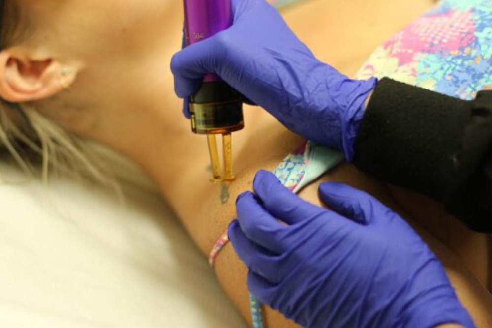 Levulan PhotoDynamic Therapy - Westside Dermatology | Dermatology About Flexile Classic