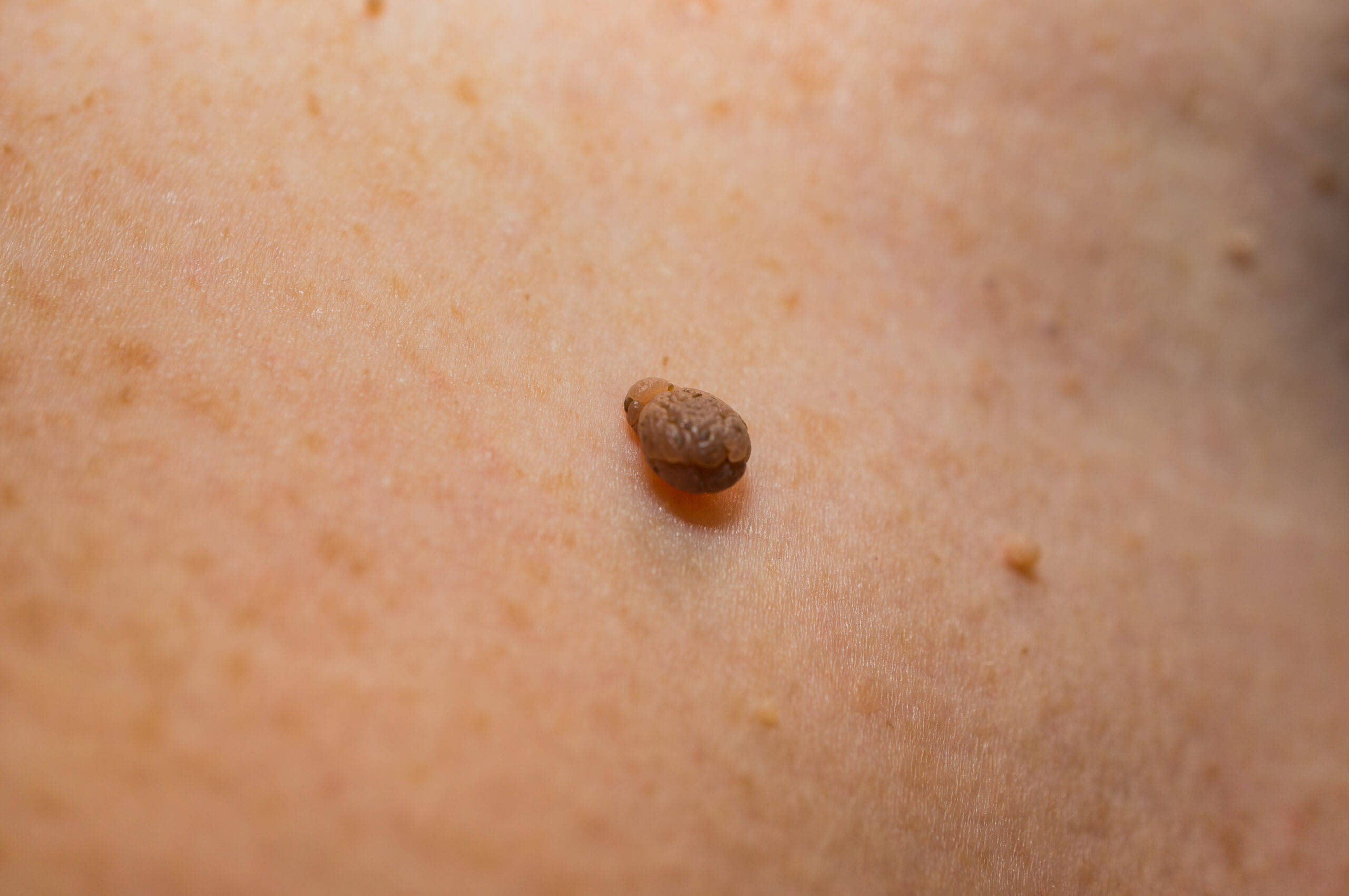 Skin Tag Removal