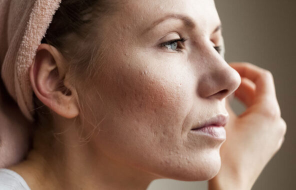 Embarrassed by Adult Acne? Your Dermatologist Can Help