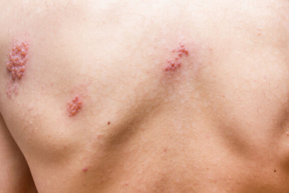 Can I Still Get Shingles (Herpes Zoster) if I Had Chicken Pox?