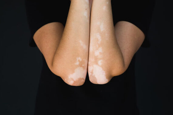 Choosing the Best Procedure for Your Vitiligo