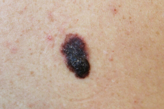 Skin Cancer Awareness Month: Looking at the Early Stages of Skin Cancer