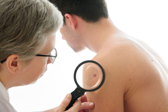 Skin Cancer Awareness Month: What Can Happen If Your Skin Cancer Goes Untreated?