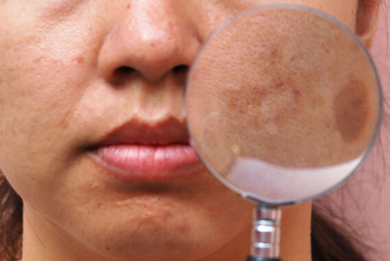 Treating Melasma and Brown Spots