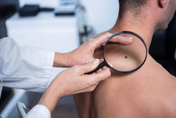 Why Your Dermatologist May Recommend Mohs Surgery for Melanoma