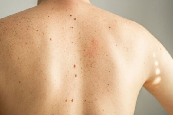 Moles vs Skin Cancer: Answering Your Pressing Questions