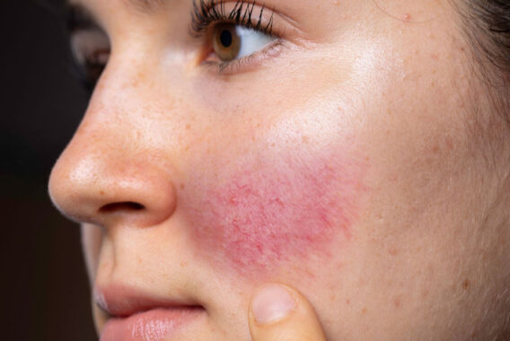 Rosacea: Common Causes and Treatments