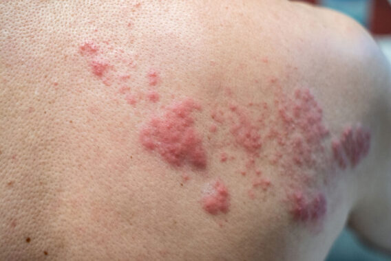 5 Common Signs of the Shingles Virus