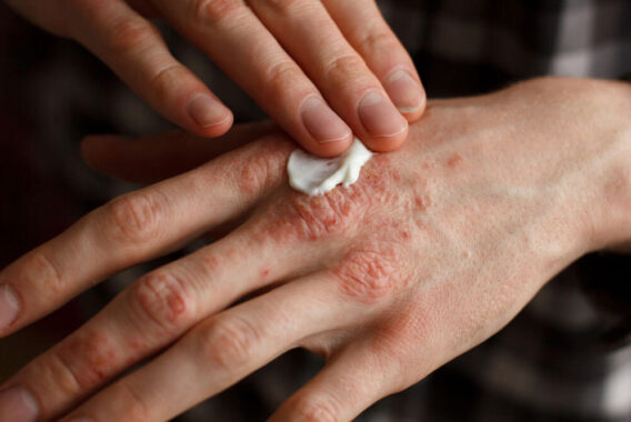 Psoriasis: Finding the Treatment That Works Best for You