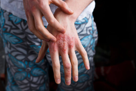 Understanding Your Dermatitis and How to Treat It