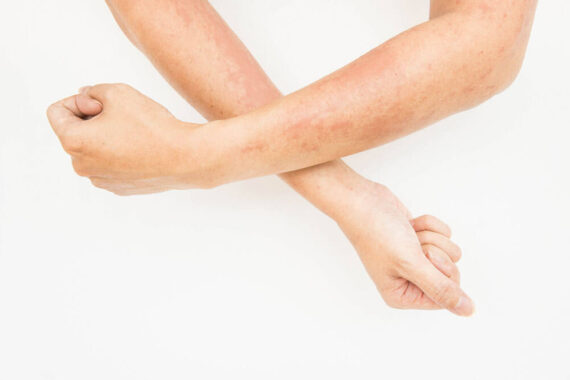Hives: The Common and Surprising Causes