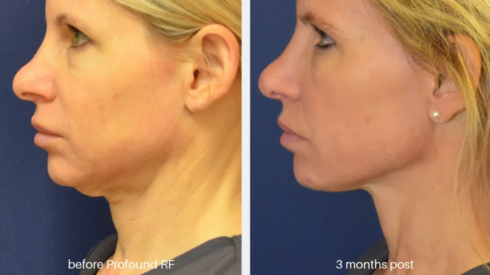 Profound-1920w - Westside Dermatology | Dermatology