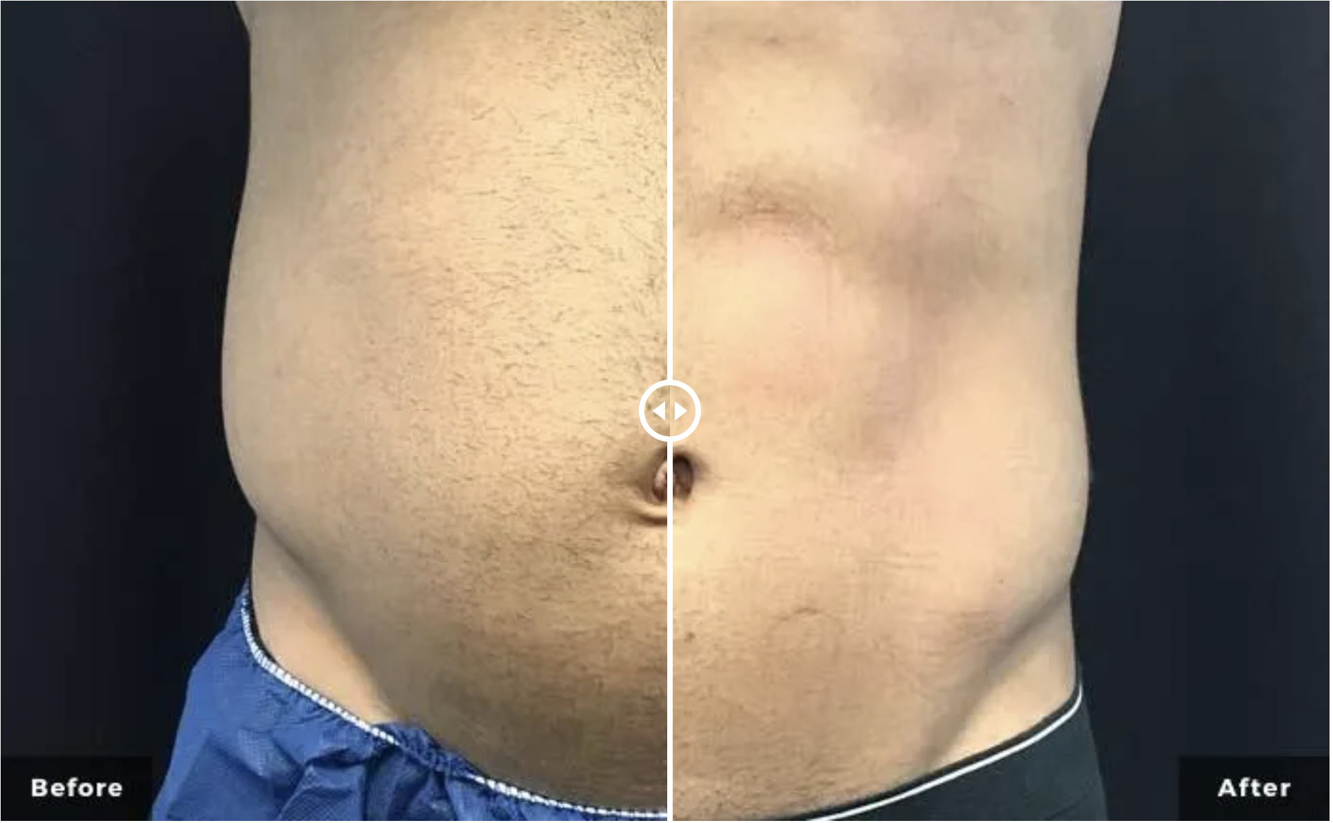 Non-Invasive Body Contouring / Body Sculpting - Westside Dermatology