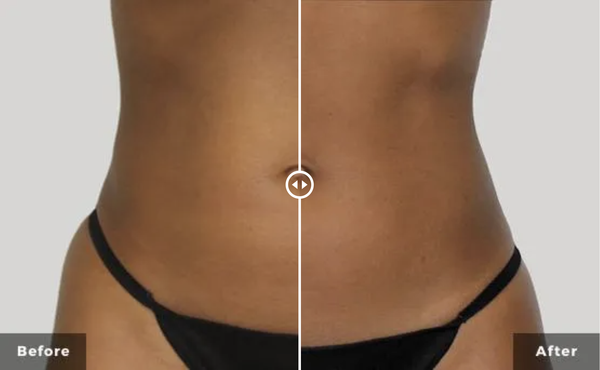 Non-Invasive Body Contouring / Body Sculpting - Westside