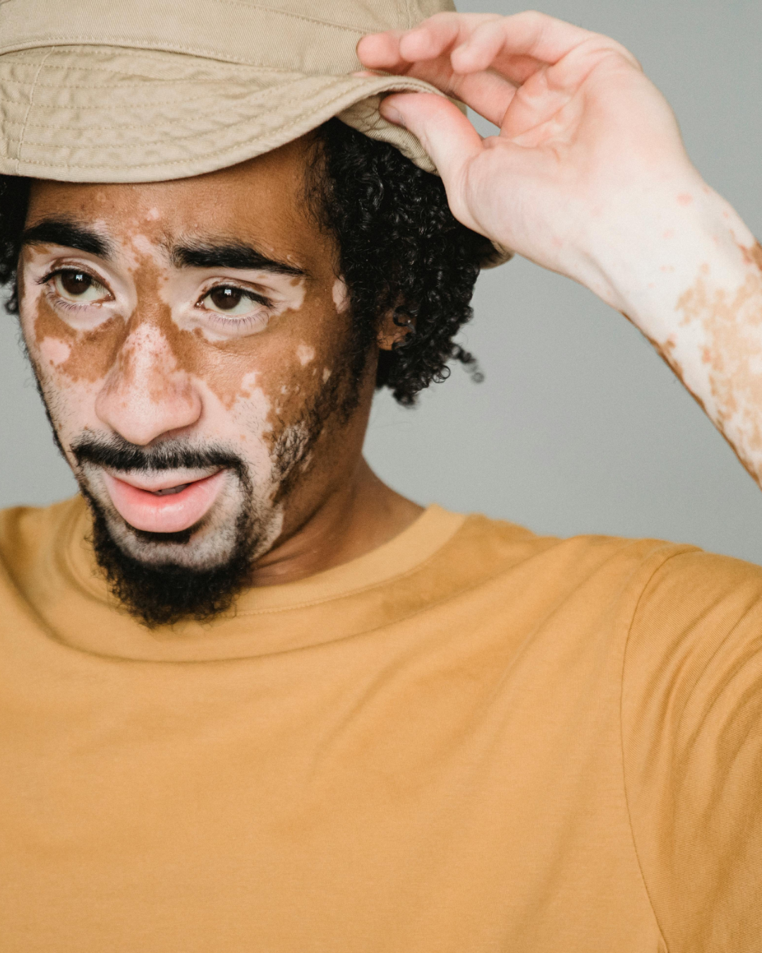 How Dermatologists Help Manage Autoimmune Skin Conditions